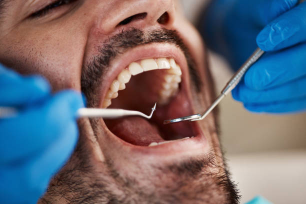 Best Chipped Tooth Repair Near Me  in Ironton, MO